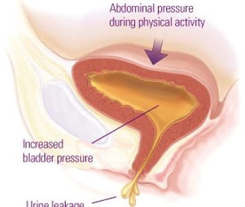 Female Urinary Incontinence, stress incontinence, urine leak, urine control