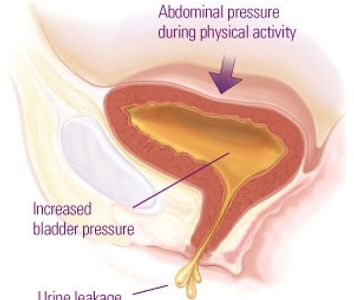 Female Urinary Incontinence, stress incontinence, urine leak, urine control