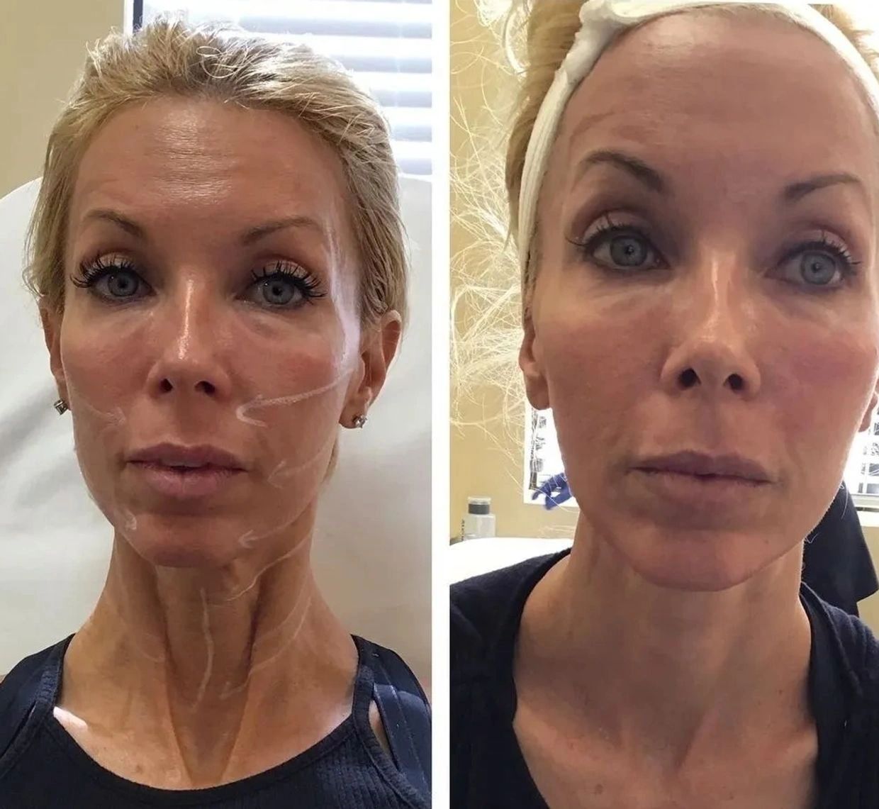 What Is Pdo Threads Aka Lunch Time Face Neck Lift