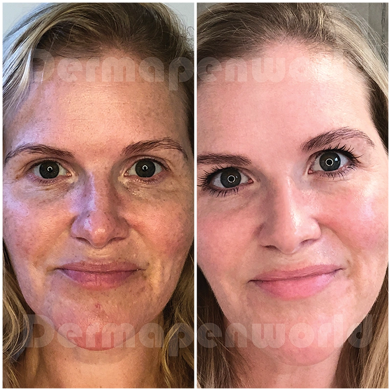 Introducing the amazing Dermapen