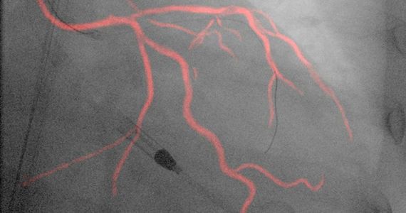 Dynamic Coronary Road Map allows a moving silhouette of the coronary arteries without contrast