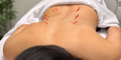 Person receiving acupuncture treatment on the upper back.