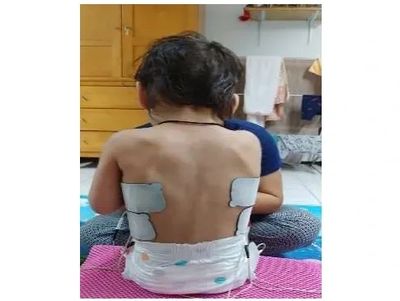 Example of NMES in a child
