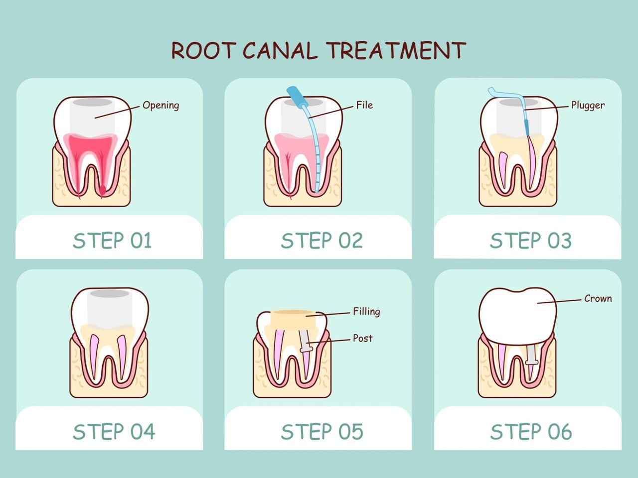 the molar dental Pune: How is root canal procedure performed?
