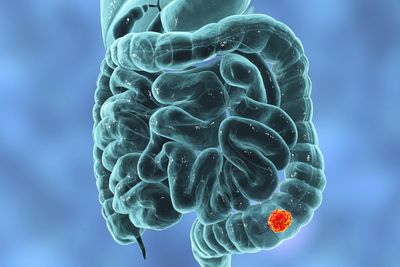  Mucosectomia trata-se da retirada de lesões maiores do esôfago, estômago ou intestino. Santos Insti