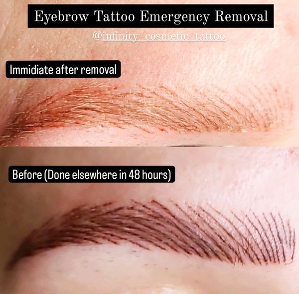 Emergency eyebrow tattoo removal near me
Emergency eyebrow tattoo removal gold coast
Removery
