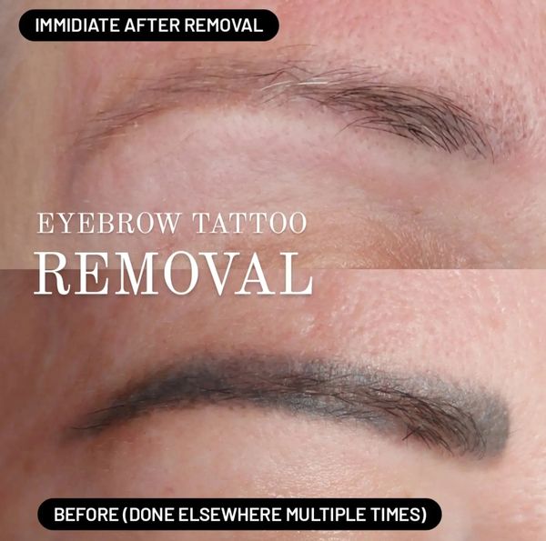 eyebrow tattoo lightening near me
eyebrow tattoo fix gold coast eyebrow tattoo removal gold coast