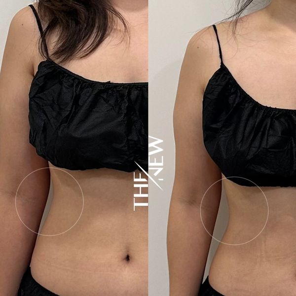 non surgical bust lift gold coast

breast firming treatment robina

chest tightening mudgeeraba
