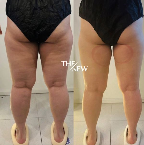 leg slimming treatment gold coast
cellulite reduction robina
thigh contouring mudgeeraba
slimming