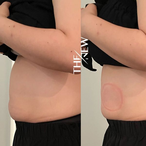 abdominal slimming treatment gold coast
belly fat reduction robina
korean body contouring technology