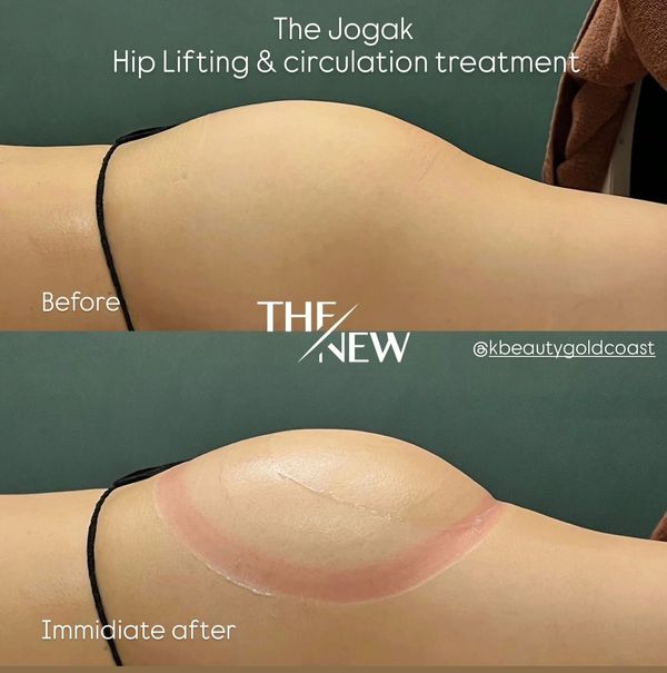 hip lifting gold coasthip lifting robina
non invasive hip lift gold coast
hip firming treatment gold