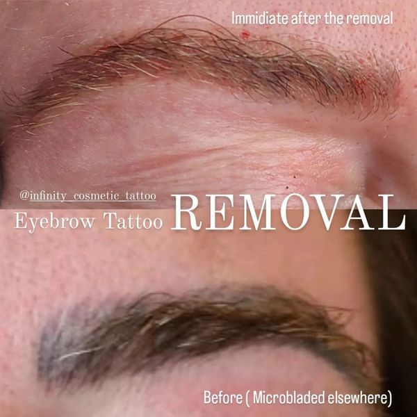 Eyebrow tattoo removal near me
Eyebrow tattoo removal gold coast
Microblading removal gold coast 