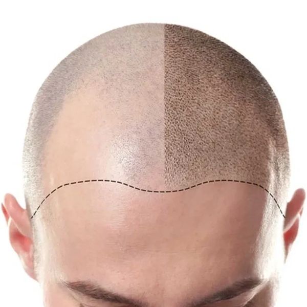 scalp micropigmentation gold coast
scalp micropigmentation near me
hair loss tattoo gold coast
hair