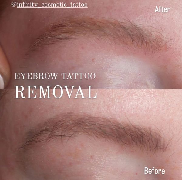 eyebrow tattoo removal near me
eyebrow tattoo removal gold coast
brow tattoo removal robina
removery