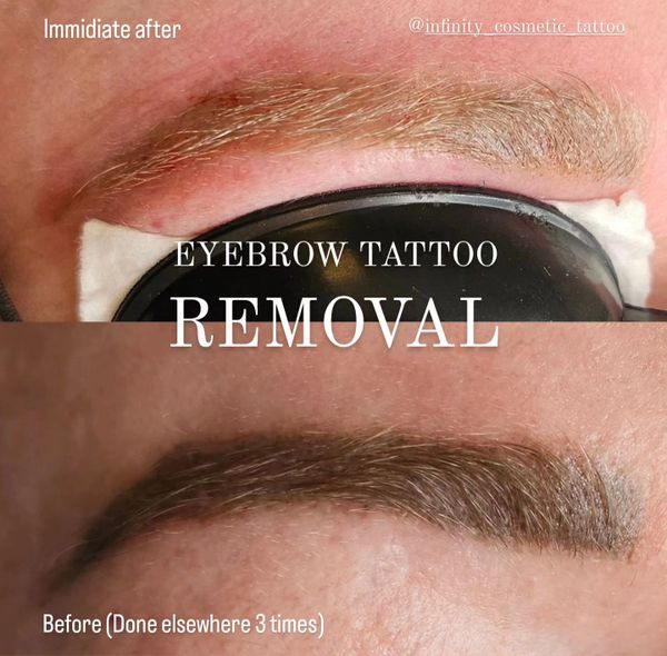 cosmetic tattoo removal gold coast
eyebrow tattoo removal near me
eyebrow tattoo removal gold coast