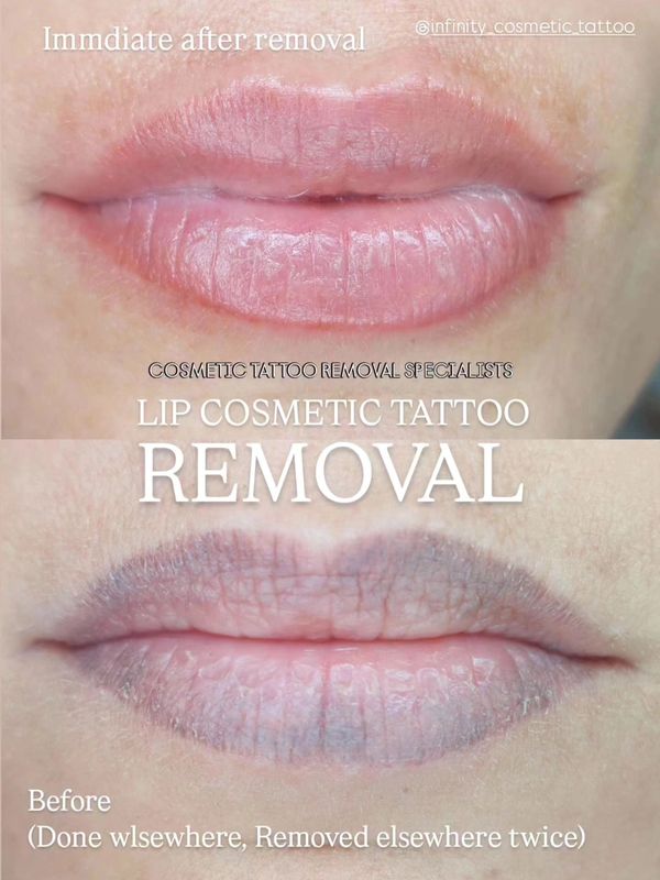 lip tattoo removal gold coast pico laser tattoo removal
