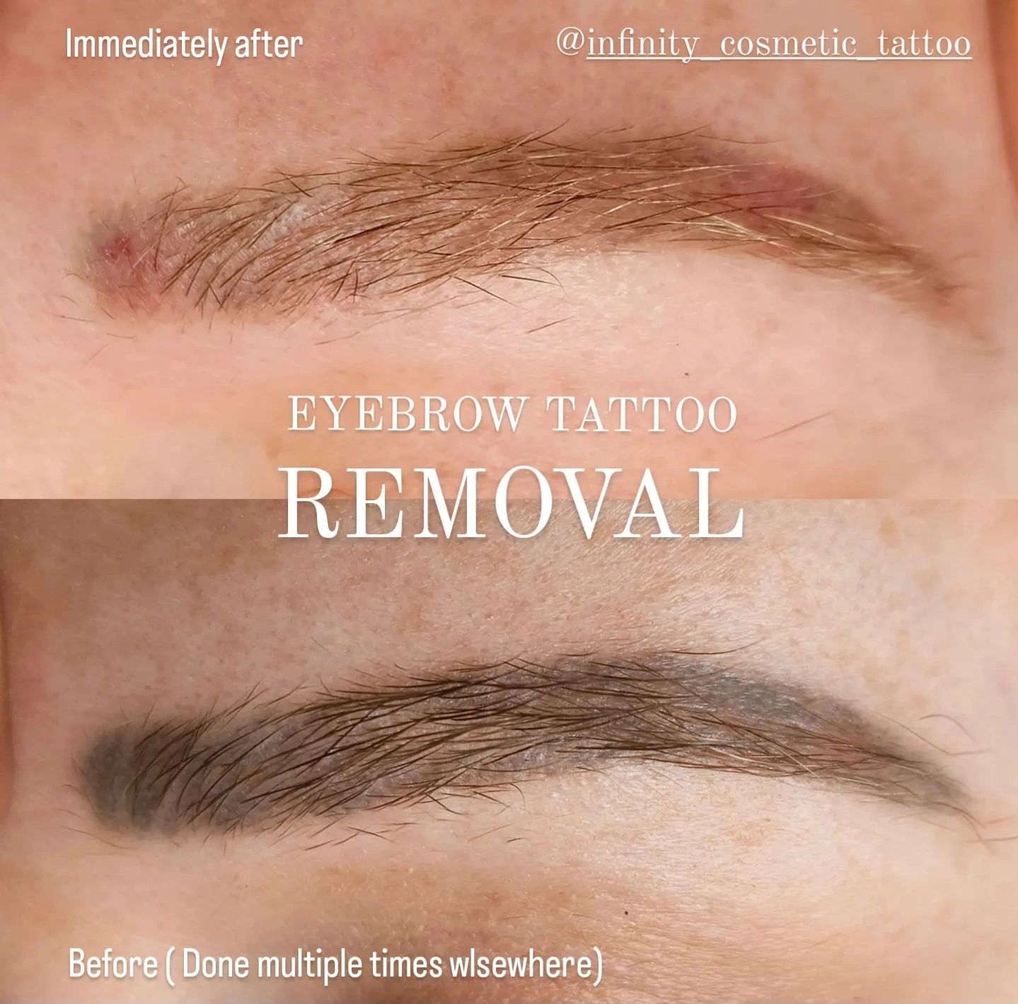 Microblading Removal  Permanent makeup removal Eyebrow tattoo removal Permanent  makeup