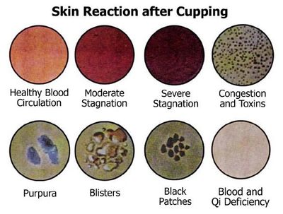 Possible skin reactions after cupping therapy at Integrated Massage and Bodywork