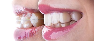 Comparación de tratamiento de ortodoncia con tratamiento ortodoncia invisible. Brackets vs invisible