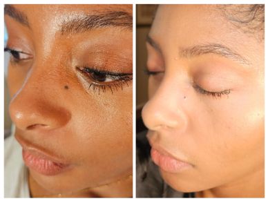 Before and after skin treatment showing clearer skin.