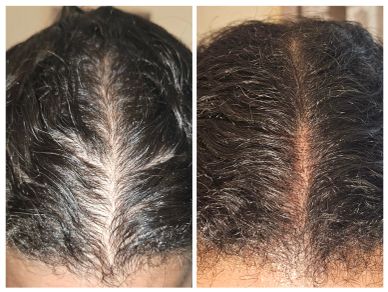 Before and after hair growth comparison on the scalp.