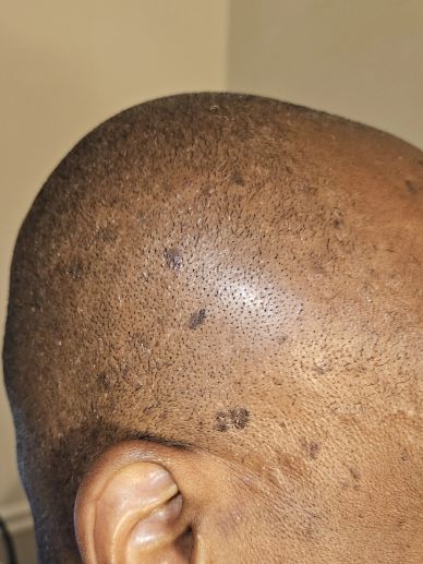 Close-up of a shaved head with dark spots on the scalp.