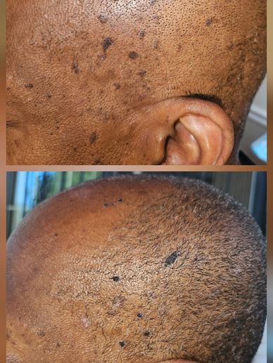 Close-up of a person's scalp with dark spots and patches.