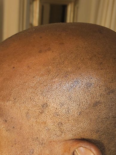 Close-up of a shaved scalp with visible pores and spots.