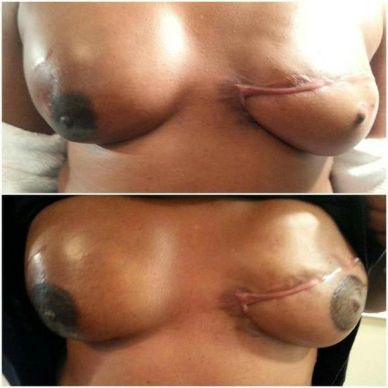 Before and after mastectomy breast reconstruction images.