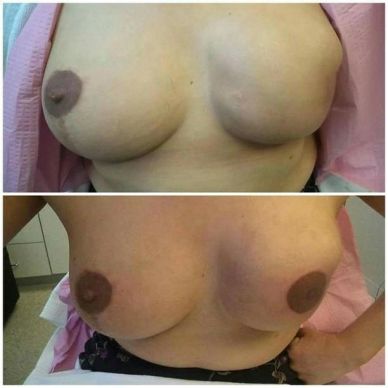 Before and after breast reconstruction images.