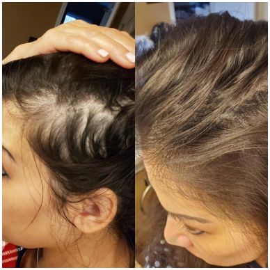 Before and after hair regrowth showing reduced hair thinning.