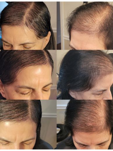 Before and after hair regrowth treatment showing noticeable improvement.