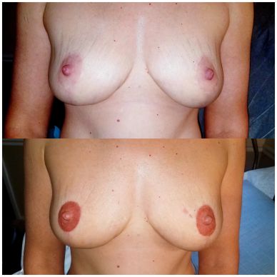 Comparison of breasts before and after areola tattooing.