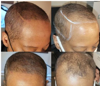Four images showing stages of hair restoration.