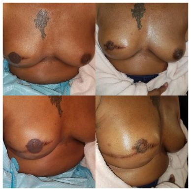 Before and after breast reconstruction surgery.