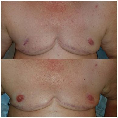 Transgender reassignment breast tissue removal surge