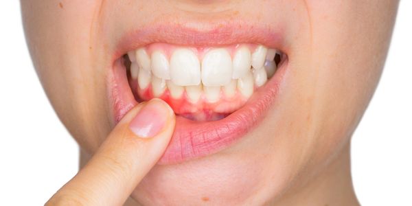Closeup of face with finger pulling lip away to show redness of gums, an indicator of gum disease.