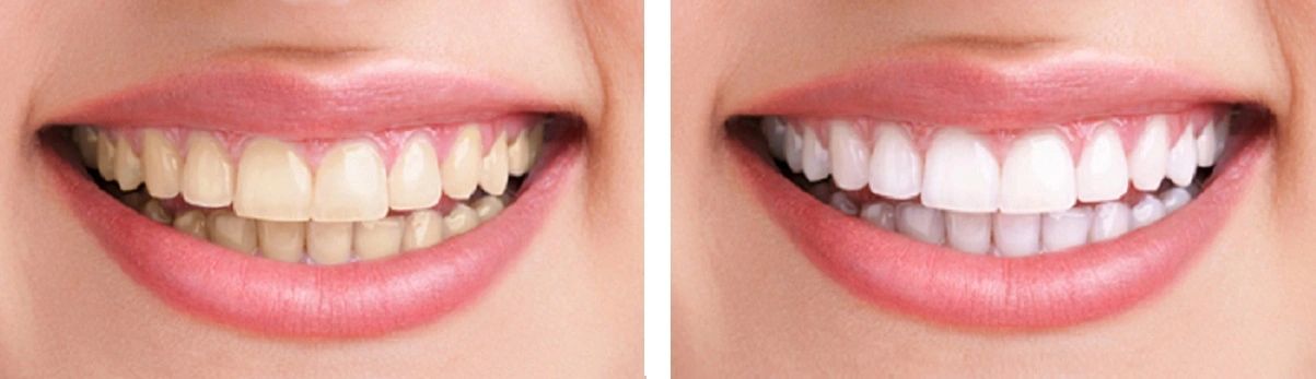 Before and after teeth whitening treatment for yellowing teeth