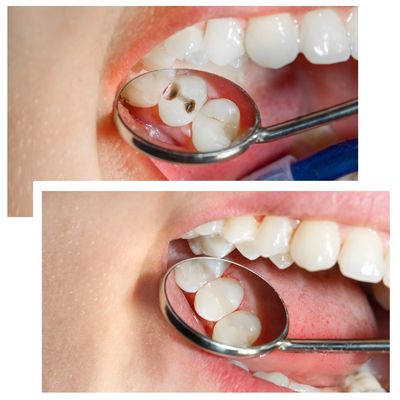 Before and after photos of tooth with two cavities and the naturally colored filling.