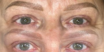 Results after 2 sessions of saline removal.