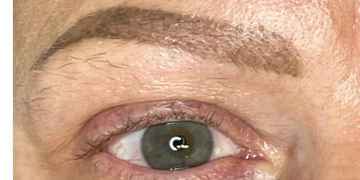 Results after 1 session of saline removal.