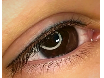 Healed results of permanent eyeliner - thin, dark lash line.