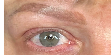Results after 1 sessions of saline removal.
