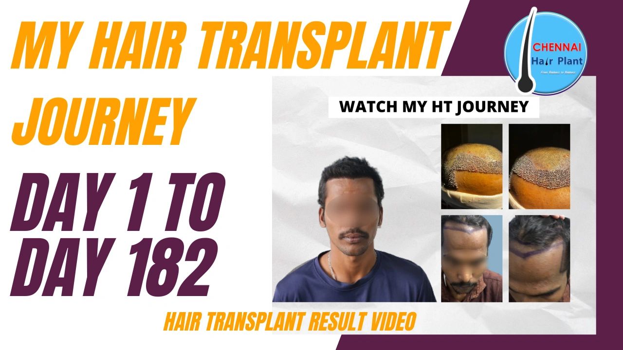 Hair Transplant Surgery Result Hair Transplant Surgery Result