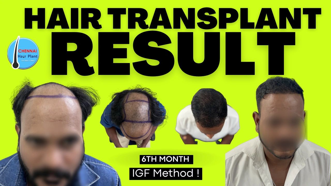 Patient Details of Hair Transplant