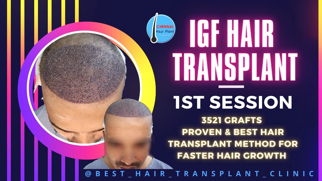 New Technique ! IGF Hair Transplant Surgery New Technique ! IGF Hair Transplant Surgery