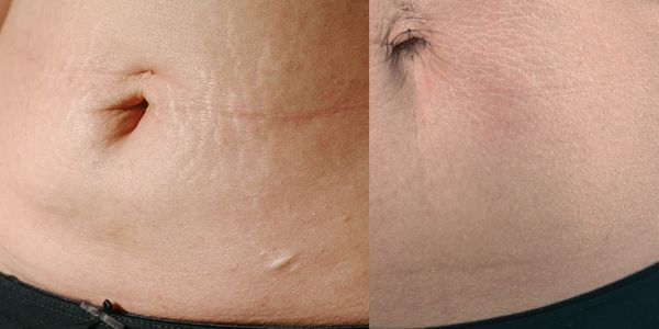 Before After Stretch Mark Revision
