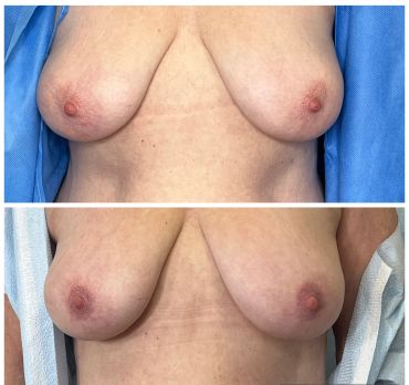 Before and after breast lift surgery showing lifted and firmer breasts.