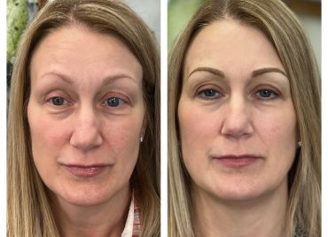Before and after facial treatment showing reduced wrinkles and smoother skin.