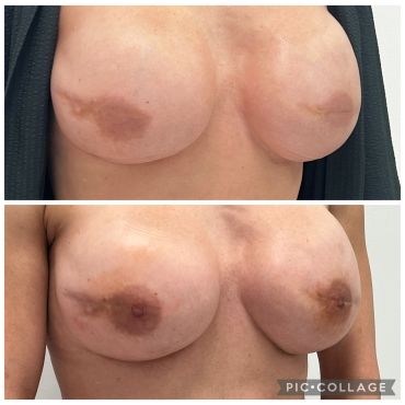 Before and after photos of breast reconstruction surgery.